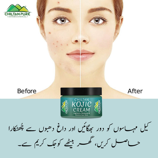 Kojic Cream – Affordable and quality body lotion cream, prevents hyperpigmentation, fades dark spots, treats melasma, minimizes discoloration – 100% pure organic 50ml - Mamasjan