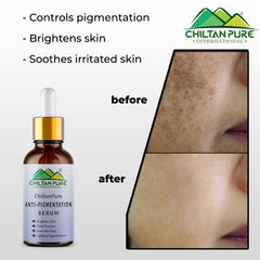 Anti-Pigmentation Serum – Brighten Skin, Lighten Pigmentation, Fade Freckles & Even Skin Tone - Mamasjan