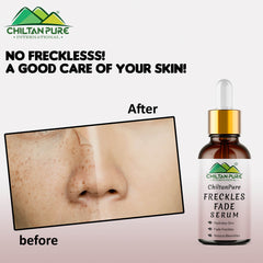 Freckles Fade Serum – Hydrates Skin, Fade Freckles, Reduce Blemishes & Lighten Pigmentation - Mamasjan