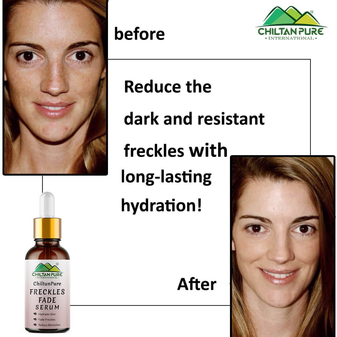 Freckles Fade Serum – Hydrates Skin, Fade Freckles, Reduce Blemishes & Lighten Pigmentation - Mamasjan