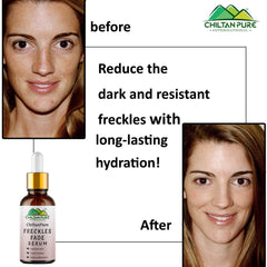 Freckles Fade Serum – Hydrates Skin, Fade Freckles, Reduce Blemishes & Lighten Pigmentation - Mamasjan