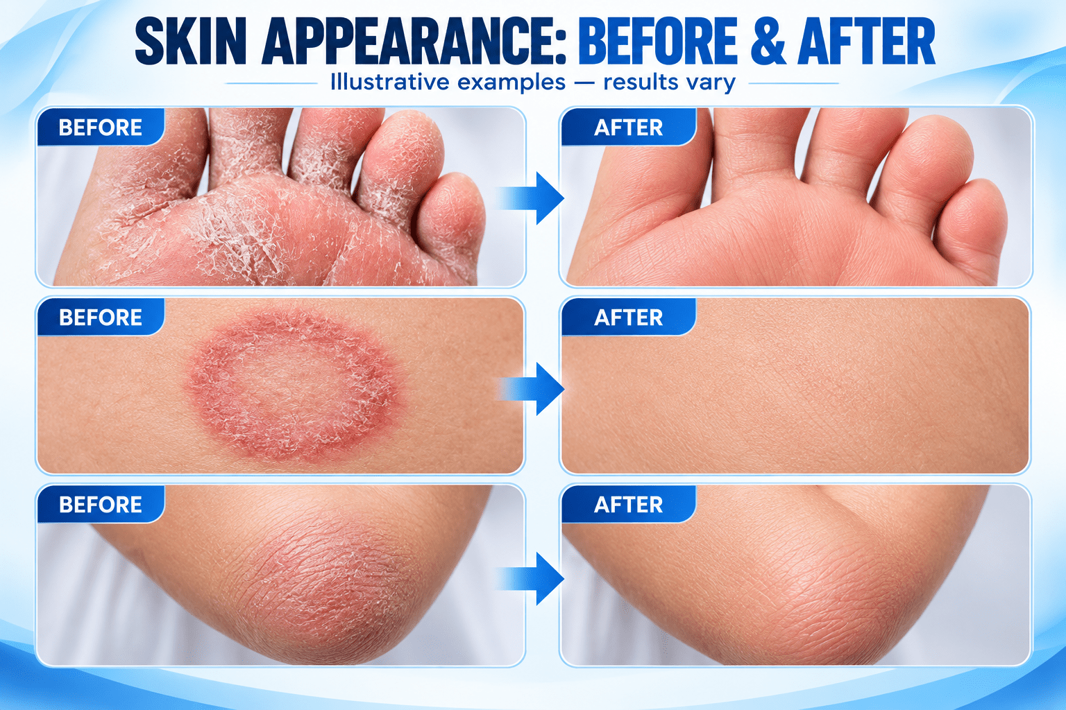 Ketoconazole Cream 2% Antifungal Cream, Relieve Itching, Burning & Flaking Associated with Athlete’s Foot, Ringworm and Jock Itch, Non-Greasy - ChiltanPure